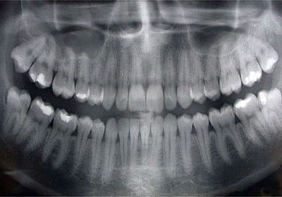 Стоимость лечения зубов нижневартовск