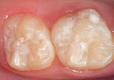 Лечение зубов цена нижневартовск